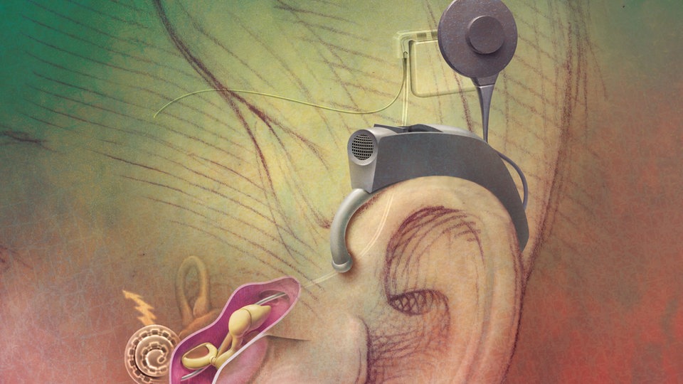 Hören Cochlea Implantat Hightech für Gehörlose Sinne Natur